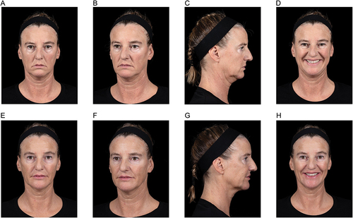 Figure 5 Full-face rejuvenation based on the MD Codes: a 49-year-old woman before (A–D) and immediately after (E–H) treatment. The woman presented with volume loss and sagging of the midface, bags and tiredness around the eyes, and a sagging and undefined jawline. Her primary concerns were jowls, bags around the eyes, and downturned oral commissures. The treatment plan for this patient was full-face rejuvenation with Juvéderm Voluma, Juvéderm Volift, and Juvéderm Volbella as described in Table 2. As she presented with deep NLFs, she received 1 mL in each NLF, resulting in a total injected volume of 13 mL HA filler. After treatment, she was assessed as having restored volume in the midface and around the eyes, with better structural support, an “exceptionally natural” outcome, and a friendlier, more confident, and energetic face. HA, hyaluronic acid; NLF, nasolabial fold.