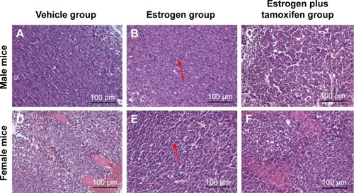 Figure 3 The images of H&E staining for tumor tissue; 400× magnification.