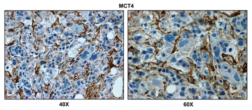 Figure 4 Lymph node associated stromal cells are glycolytic. Paraffin-embedded sections of human breast cancer-positive lymph nodes were immunostained with antibodies directed against MCT4. Slides were then counterstained with hematoxylin. Note that MCT4 is highly expressed in the stromal compartment of positive lymph nodes. Two representative images are shown. Original magnification, 40x and 60x, as indicated.