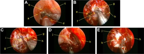 Figure 1 Intraoperative successive endoscopic images of an esthesioneuroblastoma case.