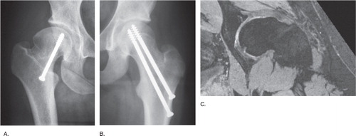 Figure 1. A. CAM-type deformity with characteristic loss of sphericity of the femoral head and decreased head/neck offset laterally and anteriorly after SCFE with in situ screw fixation. B. SCFE with loss of sphericity of the femoral head and decreased head/neck offset laterally and anteriorly and in situ screw fixation. C. Radial reconstruction of a MRI 3T scan showing anterior CAM-type deformity with the characteristic loss of sphericity of the femoral head and decreased head/neck offset anteriorly at 15 years after SCFE with in situ screw fixation.