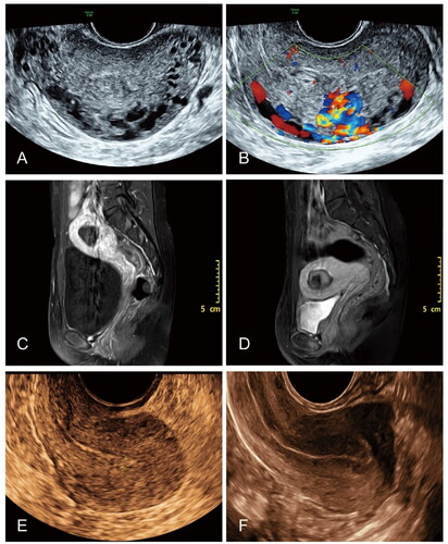 Figure 1. Image profile of a 24-year-old patient with UAVF. (A) Ultrasound images of the patient with uterine arteriovenous fistula. (B) Grayscale ultrasound showed thickening of the myometrium, and no echo in local pipe-like/honeycomb shape. Color Doppler showed multicolored blood flow signals in the anechoic region. (C) The pre-HIFU MR image showed a lesion located at the bottom of the uterus. (D) The post-HIFU MR image showed no perfusion in the lesion located at the anterior wall of the uterus. (E) Ultrasound image of uterus 1 month after HIFU showed that the lesion reduced. (F) Ultrasound image of the uterus 12 month after HIFU showed good endometrial continuity and good triple line endometrial pattern.