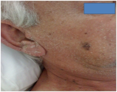 Figure 1 Scaling of the diffuse confluent erythema all over the patient’s face.