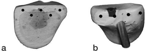 Figure 2. Medial (a) and lateral (b) views of fracture fragment demonstrating marker placement on the fracture fragment. The solid circle represents the fracture segment markers visible after reduction and fixation.