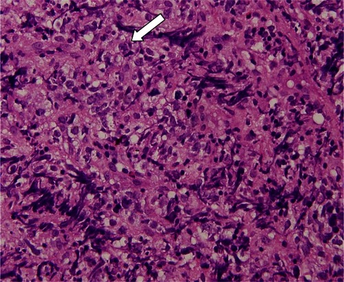 Figure 6 Section showing monotonous proliferation of large centroblast-like lymphoid cells having round to irregular nuclei, with vesicular chromatin and distinct 1 to 3 nucleoli and a moderate amount of cytoplasm (arrow).