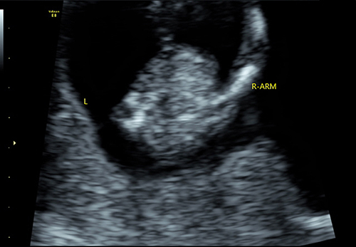 Figure 1 Two-dimensional ultrasound: the left upper limb of the fetus is not visible.