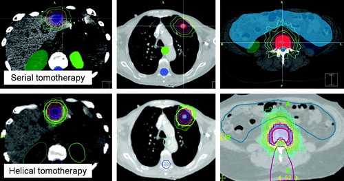 Figure 1.  Display of serial (top figures) and helical tomotherapy planned dose distributions for a liver metastasis, primary lung tumor, and spinal lesion. Doses are displayed as 100% of prescribed dose in blue, 95% in red, 70% in yellow, and 50% in green. Note the planning tuning structures in helical tomotherapy plans; yellow hull structure for both lung and liver lesion, and purple wedge for spinal lesion.