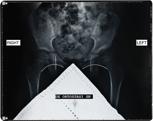 Figure 7. X-Ray of the pelvis at 4 years and 6 months of age. The white lines display two continuous Shenton lines. The Shenton line is an imaginary curve drawn along the inferior border of the superior pubic ramus and along the inferior border of the neck and head of the femur on an anteroposterior pelvic radiograph. Disruption of the Shenton line indicates a hip dislocation or subluxation, while in normal anatomy it should be continuous and smooth.