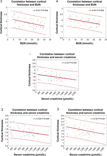 Figure 2 Cortical thickness–clinical correlation. There were four local peak vertices in right prefrontal cortex (white dots in the figure, 1, 2, 3, and 4 represent Peak 1, Peak 2, Peak 3, and Peak 4 separately). The correlations were performed between the cortical thickness in four peak vertices and clinical information across patients with ESRD. The correlations were considered significant at a threshold of P<0.05.