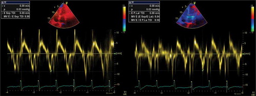 Figure 4. Tissue doppler imaging showing the relationship between lateral e’ and medial e’ velocities: Medial e’ > Lateral e’ suggestive of constrictive process (‘annulus reversus’)
