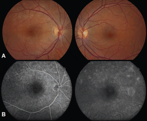 FIGURE 1  Fundus photographs (A) and fluorescein angiogram (FA) (B). Retinal pigment epithelial changes and foveal granularity are seen in the right eye (left), and the left fundus (right) is normal (A). FA of the right eye reveals pinpoint hyperfluorescent spots that stain late (B).