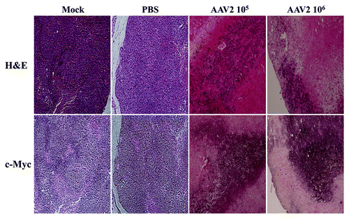Figure 8. AAV2-induced necrotic death of MDA-MB-435 xenografts correlated with enhanced c-Myc staining. Tumor sections were examined with H&E staining and further stained with c-Myc antibody. Identical areas in both types of stained tumor sections showed darker areas of c-Myc staining in cells surrounding areas of necrosis induced upon AAV2 infection.