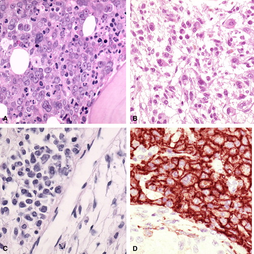 Figure 1.  A. Patient 1. The bone marrow trephine biopsy shows massive infiltration with megakaryoblasts (HE stain, 200×) B. Patient 3. The bone marrow shows infiltration with atypical histiocytic cells. Edema is noted in the background (HE stain, 200×) C. Patient 3. The testis biopsy shows interstitial infiltration with atypical histiocytes (HE stain, 300×). D. Patient 3. The atypical infiltrate in the testis expresses the monocyte-histiocyte marker CD14 (immunoperoxidase stain, 300×).