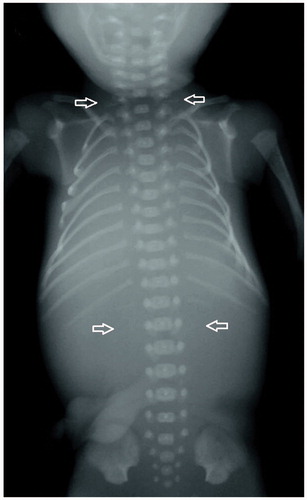 Figure 1. Radiograph of a fetus with both rudimentary cervical ribs and absent 12th thoracic ribs.
