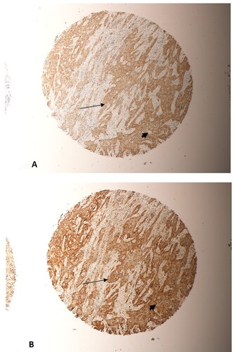 Figure 6. Represents two sections taken from the same tumour, a grade 2 OSCC from the jaw, on the microarray. (A) beta-Catenin staining; (B) SALL4 staining. Significant overlap between SALL4 and beta-Catenin in their staining of tumour cells (thin arrows, (A) and (B)) could be seen. Tumour cells predominantly express SALL4 and beta-Catenin in their nuclei and cytoplasm (arrow heads, (A) and (B)). (Magnification X10).