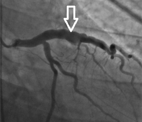Figure 3. Coronary angiogram showing severe ectasia of left anterior descending artery (LAD) (see the white arrow).