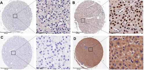 Figure 1 Representative samples of immunohistochemical staining of nucleus (A) weak staining; (B) strong staining) and cytoplasm (C) weak staining; (D) strong staining).