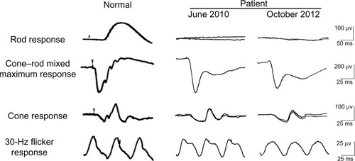 Figure 1 Scotopic electroretinograms elicited by a blue stimulus of 5.2×10−3 cd-s/m2 after 30 minutes of dark adaptation. The cone–rod mixed maximum response was elicited by a white flash of 44.2 cd-s/m2. The cone response and a 30 Hz flicker response were elicited by white stimuli of 4 cd-s/m2 and 0.9 cd-s/m2, respectively, on a blue background of 30 cd/m2. The electroretinograms were recorded on June 2010 and October 2012.