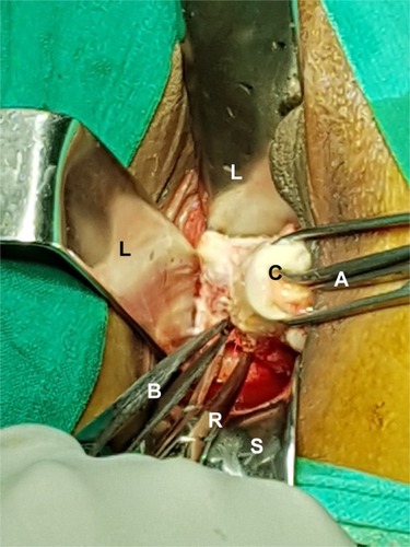 Figure 4 Coagulation of uterosacral ligament close to cervix by bipolar forceps (B) between prongs of right angle forceps (R).