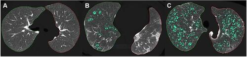 Figure 1 Representative images of emphysema quantification: Emphysema area (green color) was automatically calculated under thresholds of –950 HU on computed tomography axial images. Application of quantification software revealed that the percentage of emphysema was 1.0% of the entire lung tissue in a 53-year-old woman (A), 6.0% in an 82-year-old man (B), and 13.0% in a 73-year-old man (C).