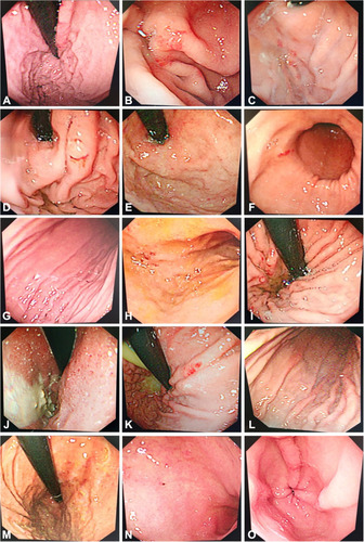 Figure 1 Gastroscopy of seven patients with SARS-CoV-2 infection. The images showed different parts of the stomach under the endoscopy. (A–E) Scattered bleeding and congestion of the gastric fundus. (F–M) Scattered bleeding of the gastric body. (N and O) Scattered bleeding of the antrum.