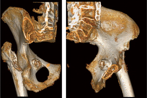 Figure 3. CT reconstruction (3D) of the entry hole through the pelvic bone, identifying the entry point of the screw to the abdomen before entering the rectum on its way to defecation.