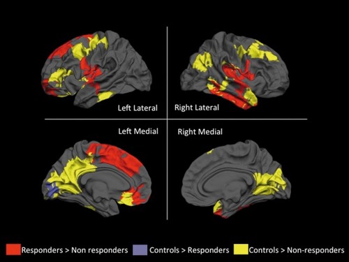 Figure 2. Voxel clusters showing differences in gyrification among responders, nonresponders, and healthy controls. Clusters of spatially contiguous suprathreshold voxels indicating higher gyrification for each between-group comparison are displayed in red, yellow, and purple. There were no clusters of reduced gyrification in these between-group comparisons. All clusters are displayed on a reconstructed average white matter surface (fsaverage in the FreeSurfer software) and sun/ived multiple testing using Monte Carlo simulation with a cluster inclusion criterion of P=0.05. The left hemisphere is on the left side of the image, and the right hemisphere is on the right side. The exact values of dusterwise probability for the clusters are presented in Table III. From reference 32: Paianiyappan L, Marques TR, Taylor H, et al Cortical folding defects as markers of poor treatment response in first-episode psychosis. JAMA Psychiatry. 2013;70:1031-1040. Copyright © 2013, American Medical Association.