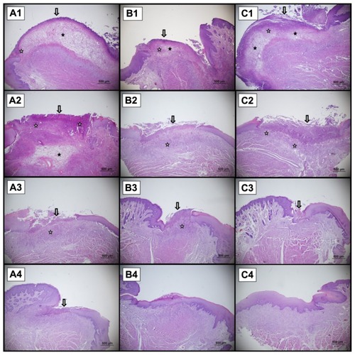 Figure 6 A sample of the histological presentation of the ulcer area. There is epithelial necrosis at the surface and subepithelial inflammatory activity (hematoxylin and eosin staining). (A) Control, (B) gel formulation (without active agent), (C) gel formulation. A1, B1, and C1 show Day 3; A2, B2, and C2 show Day 6; A3, B3, and C3 show Day 9; A4, B4, and C4 show Day 12.Notes: Arrow denotes epidermal injury. ★ shows neutrophil and mononucleer cell infiltration. ✰ shows odema in lamina propria.