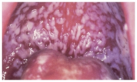 Figure 1 Pseudomembranous oropharyngeal candidiasis.