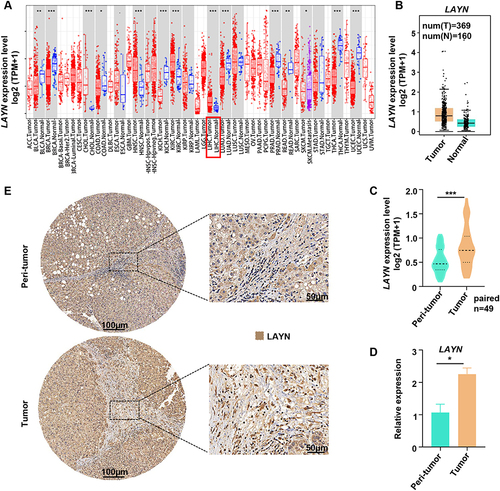 Figure 1 Expression of LAYN in HCC. (A) Pancancer analysis of LAYN expression in multiple human cancer types using the TIMER database. (B and C) mRNA expression of LAYN in HCC tumor tissues (n=369) and normal tissues (n=160) analyzed by the GEPIA database (B), as well as in paired HCC tumor and peri-tumor tissues using the TCGA RNA-sequencing data (C) (n=49). (D) Analysis of LAYN mRNA expression in paired HCC tumor and peri-tumor tissues (n=13). (E) Representative images of immunohistochemistry for LAYN protein expression in HCC tissues. Student’s t-test (C and D) was performed, and the data were presented as the mean ± SEM. Results were replicated (n = 3 experiments) (D and E). *P < 0.05; ***P < 0.001.