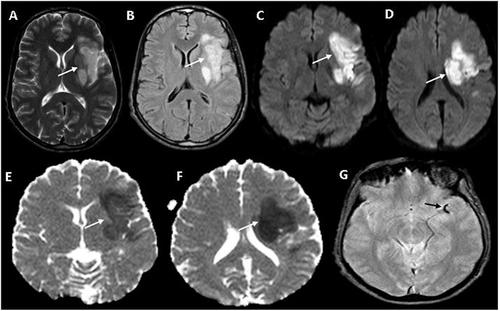 Figure 1 Brain MRI images: Axial T2WI (A), FLAIR (B), DWI (C and D), and Apparent Diffusion Coefficient (E and F) map of a patient’s brain reveal acute infarction in the left middle cerebral artery territory. The scans show significant hyperintensity in the left insular cortex, body of the caudate nucleus, posterior part of the lentiform nucleus, and lateral part of the inferior frontal lobe, with evident restricted diffusion (white arrow). The gradient echo image (G) displays a blooming artifact in the M2 segment of the left middle cerebral artery (black arrow), likely indicating a thrombosed vessel.