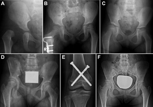 Figure 3. An example of overgrowth of the affected limb after treatment of DDH. A girl underwent anterolateral open reduction at age 1.5 years (A) and femoral osteotomy at age 5 years. At 2 months post-osteotomy FHHD was not distinct (B). However, FHHD became +14 mm at age 8.5 years (C) and +19 mm at age 11.5 years (D) resulting in pelvic tilt. She underwent percutaneous epiphysiodesis using transphyseal screws (E) and eventually had a level pelvis at age 15 years (F).