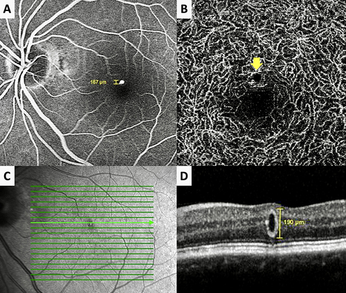 Figure 3 Case 7, Left eye of a 72-year-old otherwise healthy woman. Mid-phase fluorescein angiogram (A) depicting the well-defined, round, hyperfluorescent intraretinal macroaneurysm with no leakage. Deep capillary plexus slab of 3×3 mm macular optical coherence tomographic angiographic section (B) delineating the round but hypodense juxtafoveal lesion (arrow). Reflectance image (C) reveals the hyporeflectant well-defined round lesion. Horizontal spectral domain optical coherence tomographic section passing through the lesion (D) depicting the vertically oval-shaped lesion with a thick hyperreflective wall and hyporeflective lumen without any associated intraretinal or subretinal fluid.