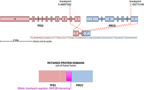 Figure 4 A diagrammatic representation is provided to illustrate the two variant gene fusions identified through targeted RNA sequencing analysis. The PRCC-TFE3 transcript consists of PRCC exon 7 fused to exons 2 of TFE3 in case 3.