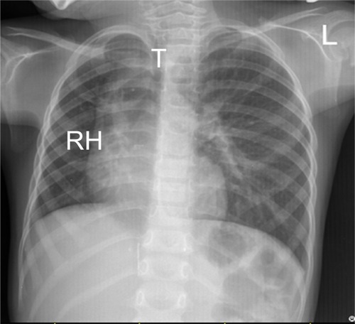 Figure 1 Posteroanterior chest radiograph showing hyperinflated left lung with reduced right lung volume.