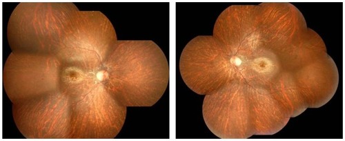 Figure 1 Right and left fundus photographs showing diffuse choroidal hypopigmentation with increased visibility of the choroidal vessels and symmetric well circumscribed macular discoloration.