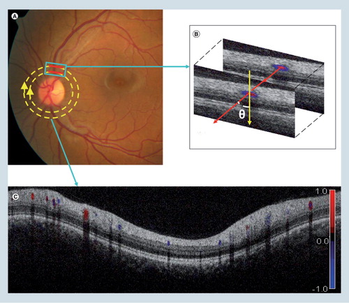 Figure 2. Doppler optical coherence tomography.(A) Fundus photograph showing the double circular pattern of the optical coherence tomography (OCT) beam scanning across retinal blood vessels emerging from the optic disc. (B) The relative position of a blood vessel in the two OCT cross-sections is used to calculate the Doppler angle θ between the beam and the blood vessel. (C) Color Doppler OCT image showing the unfolded cross-section from a circular scan. Arteries and veins could be distinguished by the direction of flow as determined by the signs (blue or red color) of the Doppler shift and the angle θ.Color figure can be found online at www.expert-reviews.com/doi/full/10.1586/eop.12.41