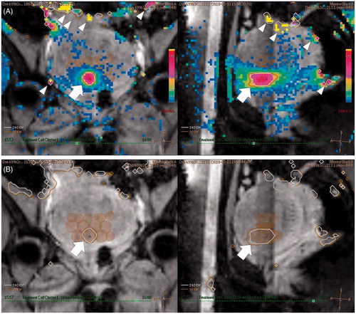 Figure 1. Example of PRF shift-based MR thermometry during MR-HIFU ablation therapy of a uterine fibroid. (A) Coronal (left) and sagittal (right) MR temperature maps obtained during HIFU sonication with a 16-mm treatment cell. The HIFU target can be seen to be heated to 68 °C (arrows) which was successful. Colour changes remote from the HIFU target are artefacts caused by motion (arrowheads). (B) Coronal (left) and sagittal (right) thermal dose maps immediately after HIFU sonication. Thermal dose contours for 240 EM (white line) and 30 EM (orange line) are demonstrated together (arrows). The semi-opaque brown ellipsoids represent the already ablated treatment cells.