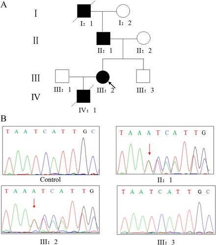 Figure 1. (A) Pedigree of the family affected with pulmonary arterial hypertension. Squares,male family members; circles, female members; closed symbols,affected members; open symbols, unaffected members; arrow, proband. (B) Sanger DNA sequencing chromatogram demonstrating the heterozygosity for a BMPR2 mutation (c.453dupA, p.I152Nfs*29).