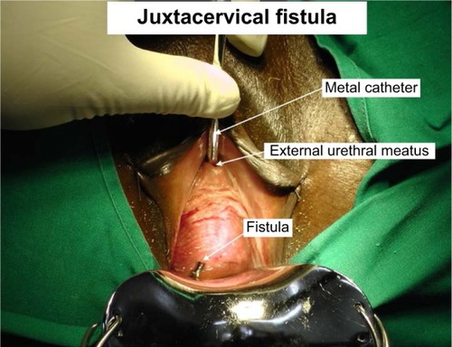 Figure 2 Intraoperative photograph showing a typical high fistula at the start of surgery.