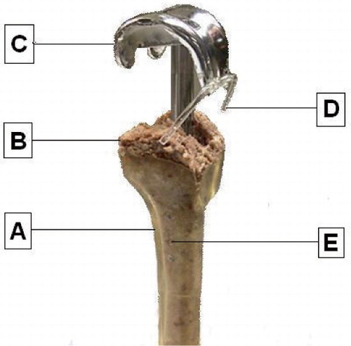 Figure 1.  The reconstructed distal femur just before implantation of the stemmed femoral component. A. Synthetic distal femur in upside-down position. B. Reconstructed condyle with IBG. C. Femoral component with a thin cement layer. D. Connector with tantalum pellets glued at the flange for RSA measurements. E. Tantalum pellet inserted at the femoral shaft.