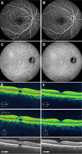 Figure 2 Fundus findings in the right eye (Case 2).