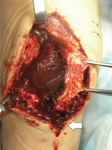 Figure 5 Intraoperative view of hematoma connecting to the distal subcutaneous area (white arrow) in case 2 (46-year-old male).