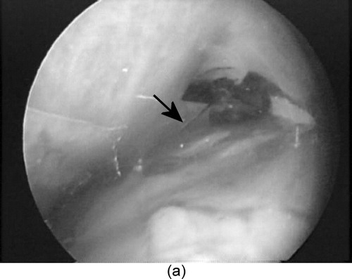 Figure 7. The second prototype (viewed beneath the pericardium by the SVP) (a) positioning for myocardial injection (needle highlighted by the arrow) and (b) performing a myocardial injection of tissue dye. (c) The injection sites viewed on the excised porcine heart. [Color version available online]