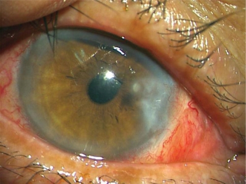 Figure 1 Clear corneal endothelial plaque was observed at the scar region of the excised pterygium.
