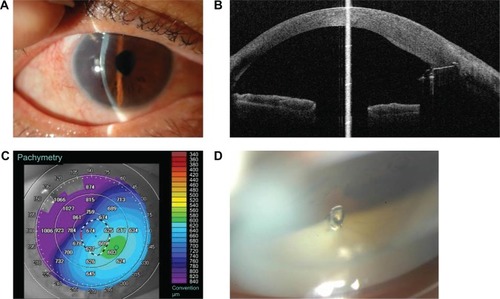 Figure 1 Photographs of the eye at 9 months after Ex-PRESS surgery.