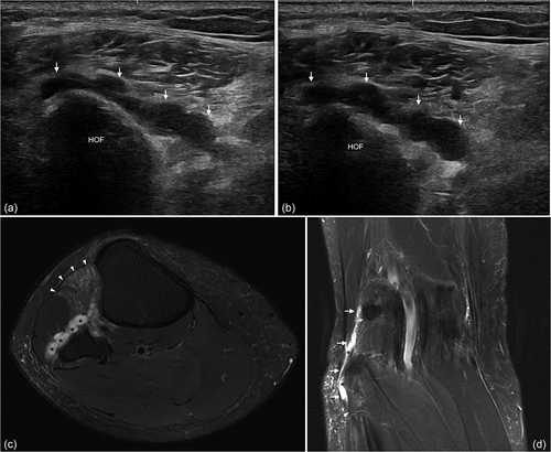 Figure 1. Musculoskeletal ultrasonographic scans (a and b) and MRIs (c and d) of knee after noting a significant foot drop. (a) longitudinal scan view, lobulated feature of deep peroneal nerve (white arrows), (b) two-week follow-up scan view, slightly enlarged in size for two weeks. (HOF: head of fibula) (c) axial T2-weighted image shows about 11 cm extent of longitudinal cystic lesion (asterisk) along common peroneal nerve and articular branch with high signal intensity. T2 high signal intensity changes probably due to denervation are shown on tibialis anterior and extensor hallucis longus muscles (arrow head). (d) sagittal T2-weighted image shows cyst (asterisk) along the track of the common peroneal nerve (white arrows) around the fibular head.