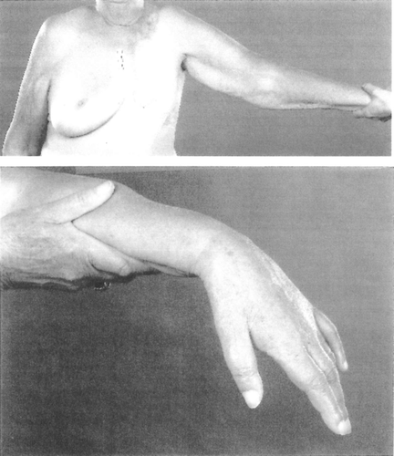 Figure 1.  Drop-hand due to radiation-induced brachial plexopathy (BPN). The hand and the arm of the patient were almost completely paralysed, and the muscles atrophied. The patient had also lost all sensory functions in the extremity. This patient had very little lymph oedema.