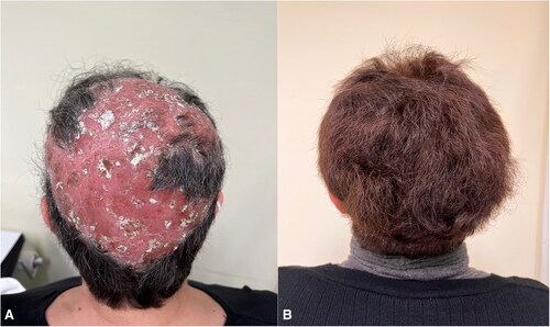 Figure 1. a) Erythema, scaling and alopecia on the scalp of a 46-year-old woman after 22 weeks of treatment with adalimumab; b) complete remission of the alopecia after 16 weeks of treatment with ixekizumab.