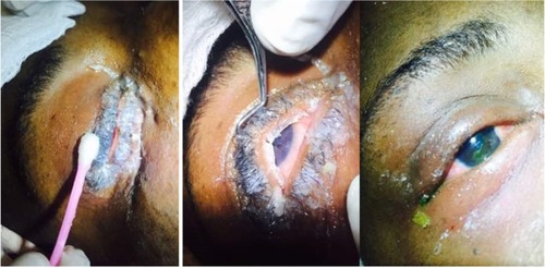 Figure 1 At presentation, before, during and after removal of superglue with a corneal abrasion seen after staining.